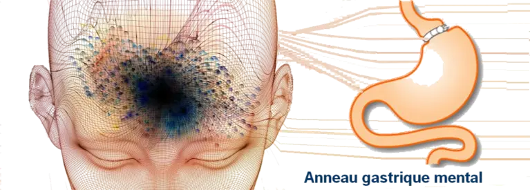 anneau gastrique hypnotique-