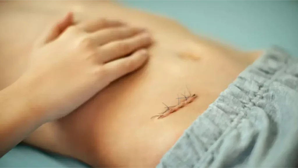 Comment reprendre du poids apr&egrave;s une appendicectomie