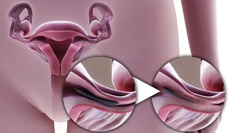 Le retrait d&rsquo;Essure am&eacute;liore-t-il d&rsquo;autres sympt&ocirc;mes