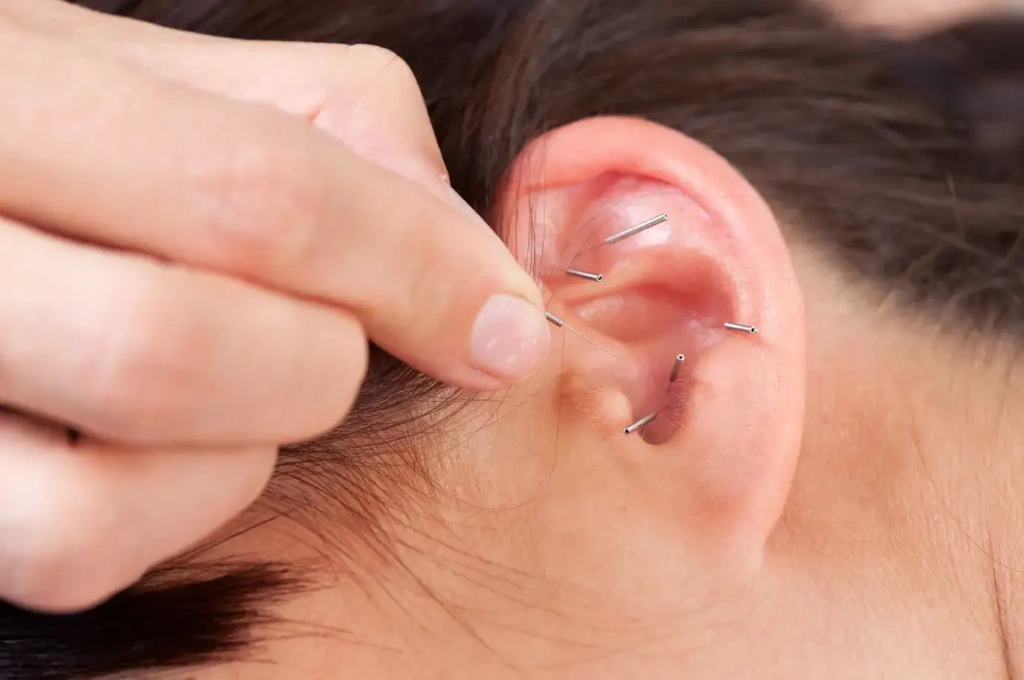 Agrafe dans l’oreille pour maigrir avis