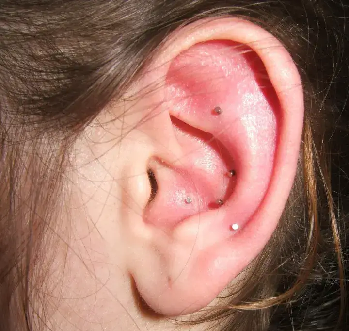 risques ou des effets secondaires &agrave; conna&icirc;tre de l'Agrafe dans l&rsquo;oreille pour maigrir